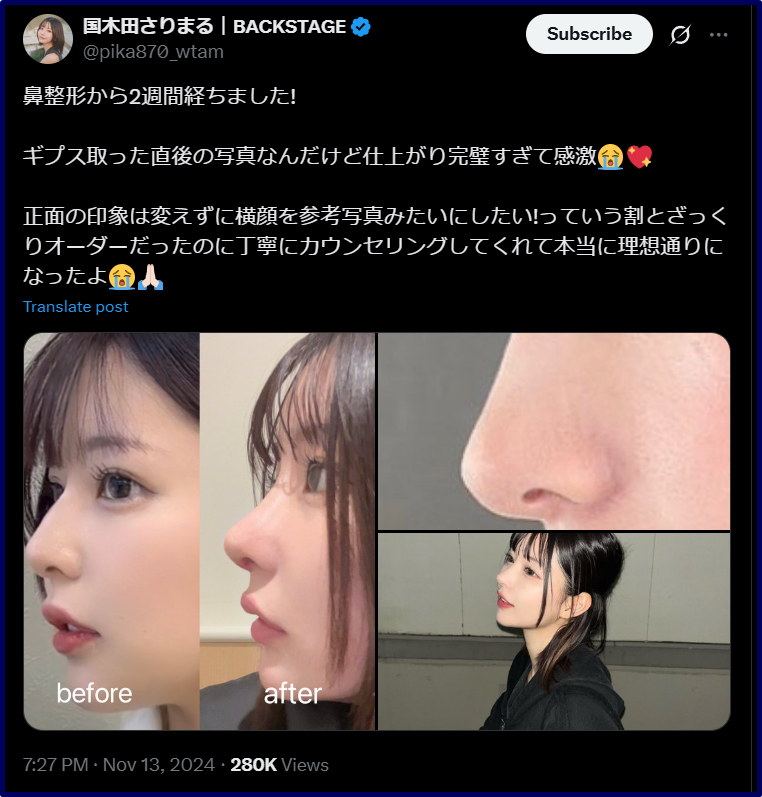 国木田さりまるが整形したのはいつ？整形前後の比較画像あり！ | なこしらべ